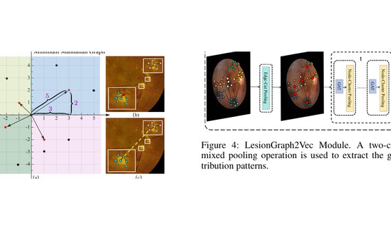 SIGraph lesion graph